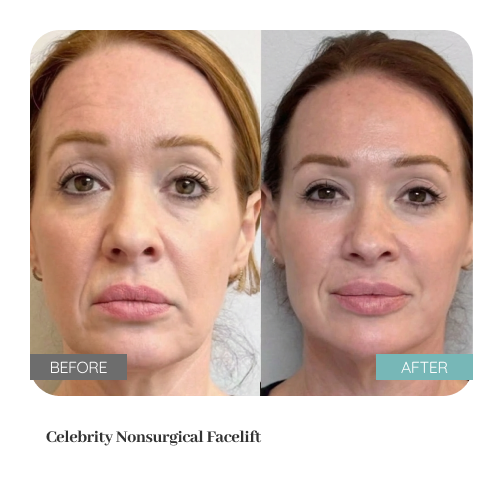 Before and after treatment result — Dr. Lanna, LC Medical Aesthetics NYC